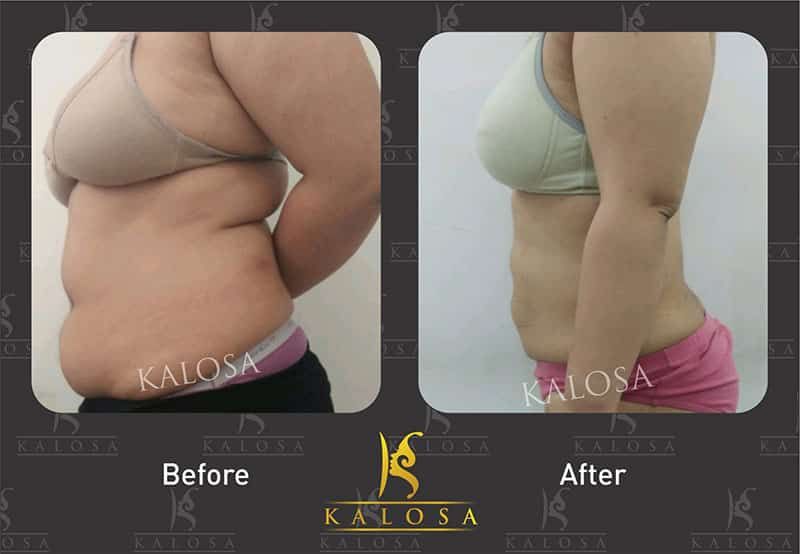 Kalosa Aesthetics & Cosmetic Gynaecology Clinic Delhi