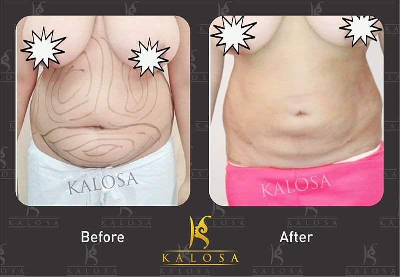 Kalosa Aesthetics & Cosmetic Gynaecology Clinic Delhi