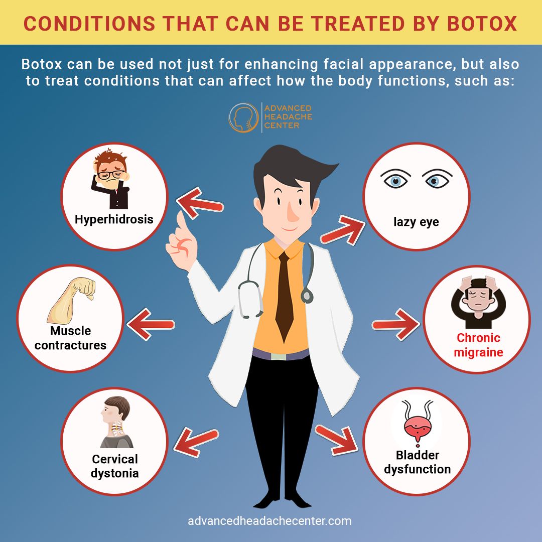 Botox for headache 