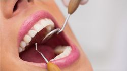 Teeth cleaning at affordable rates