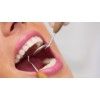 Teeth cleaning at affordable rates