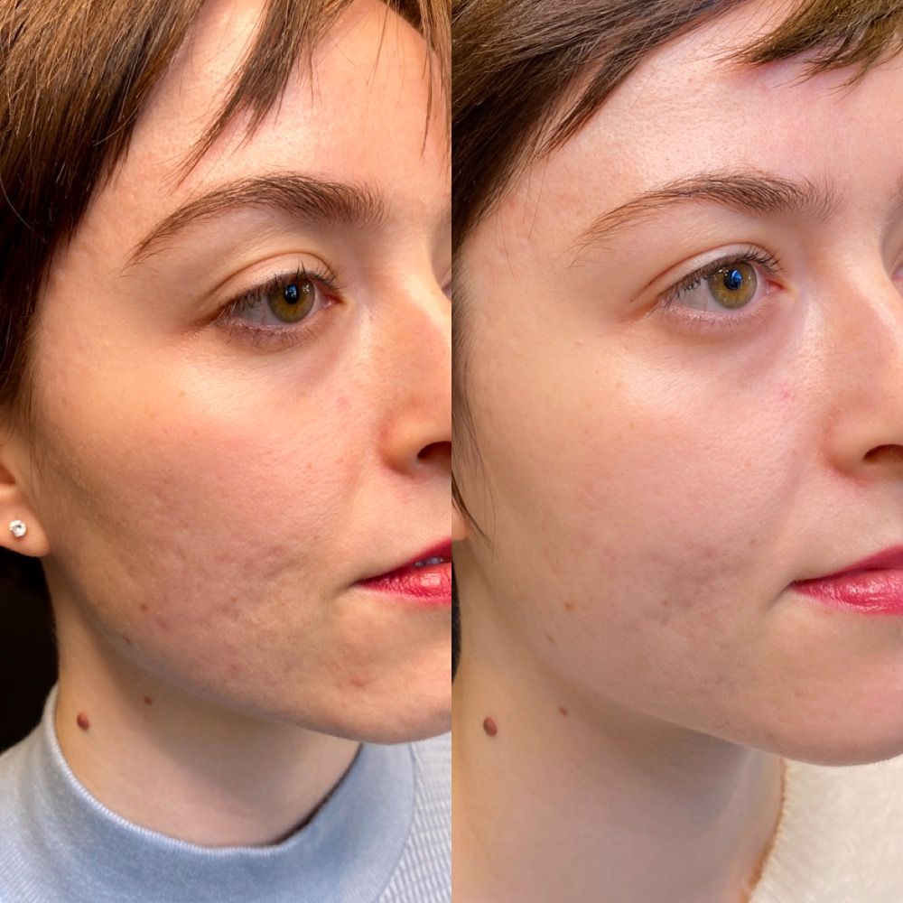 Subcision scar treatment in california