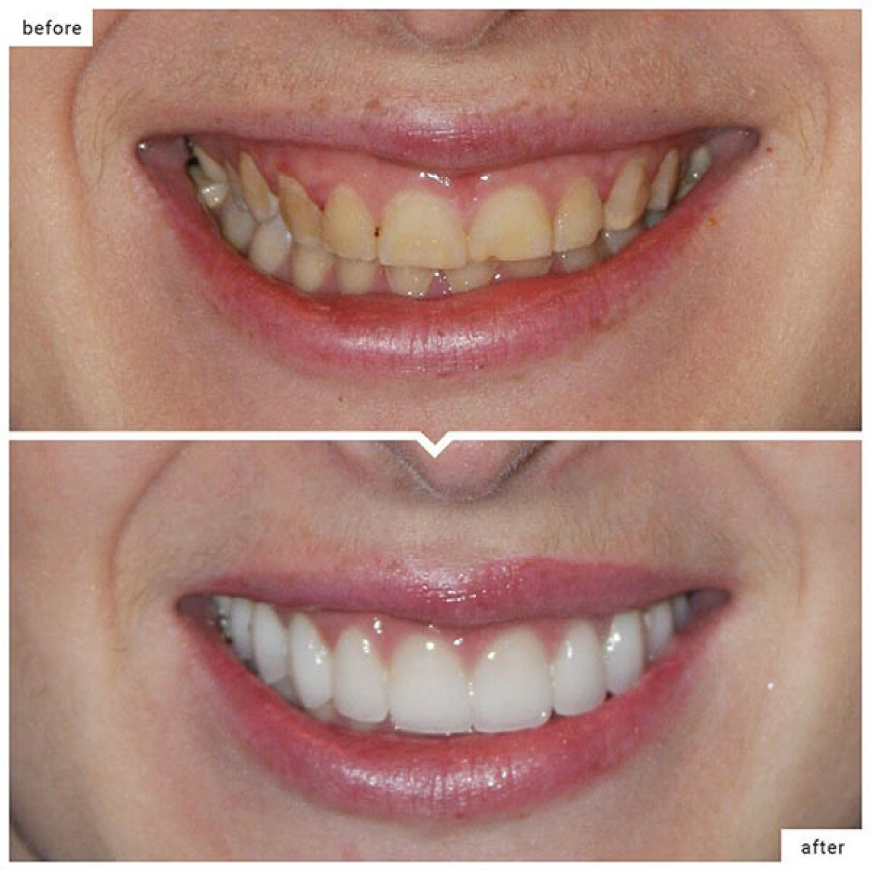 Dental Veneers in Lower Manhattan, Downtown NYC