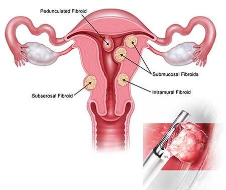Myosure Fibroid and Polyp Removal