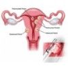 Myosure Fibroid and Polyp Removal