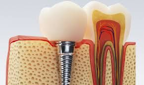Root canals