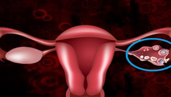 Hamilelikte Kist Tedavisi ve Oluşumu