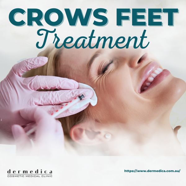 Crows Feet Treatment available at Dermedica 
