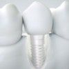 Dental implants treatment in Aberdeen