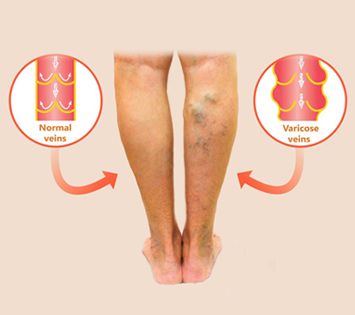 Ambulatory Phlebotomy