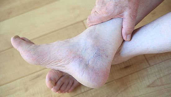 Sclerotherapy for Spider Veins