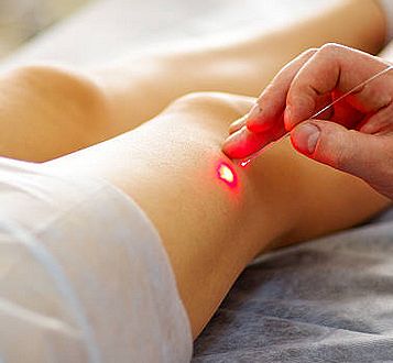 Laser Therapy for Spider Veins