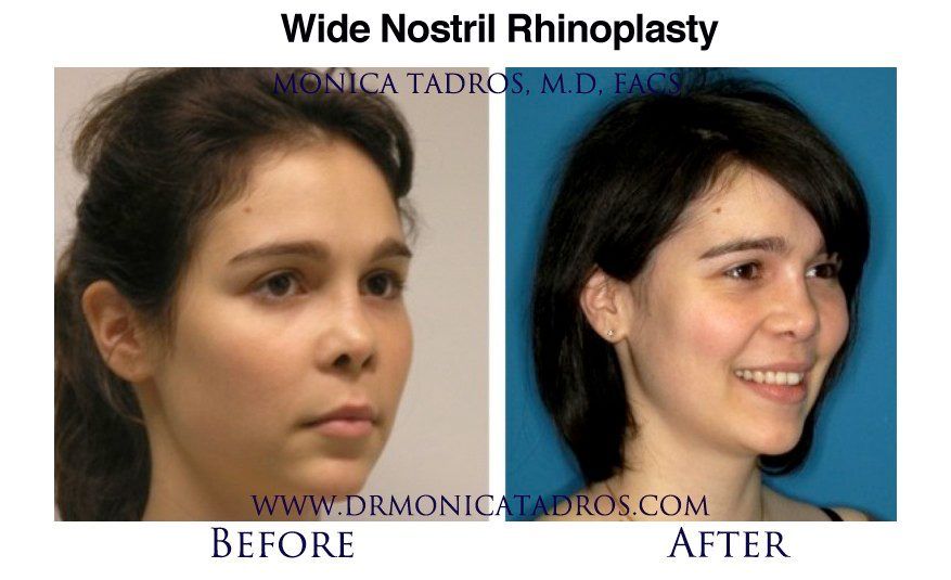 Nostril Reduction Surgery