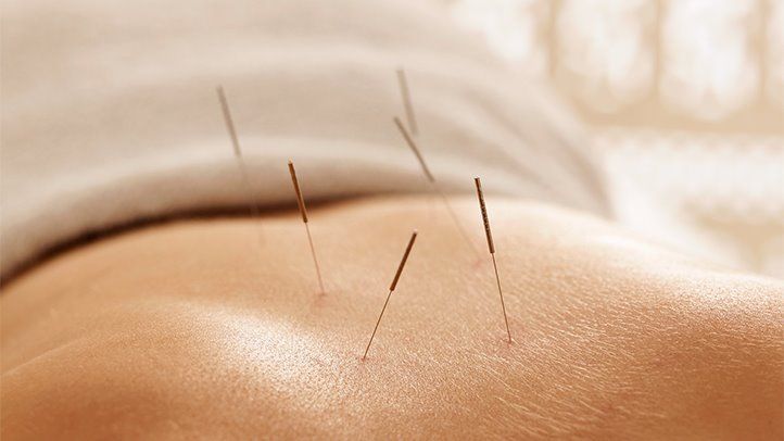 Acupuncture 